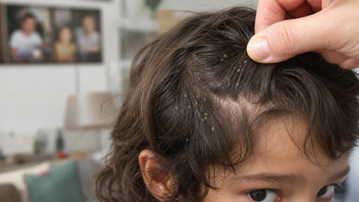 Photos de poux et de lentes dans les cheveux : les reconnaître et les distinguer des pellicules